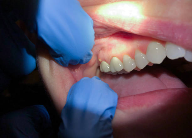 Best Emergency Root Canal Treatment in Riviera Beach, MD